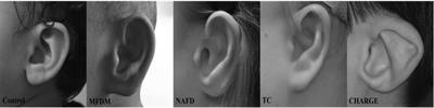 AI-based diagnosis in mandibulofacial dysostosis with microcephaly using external ear shapes